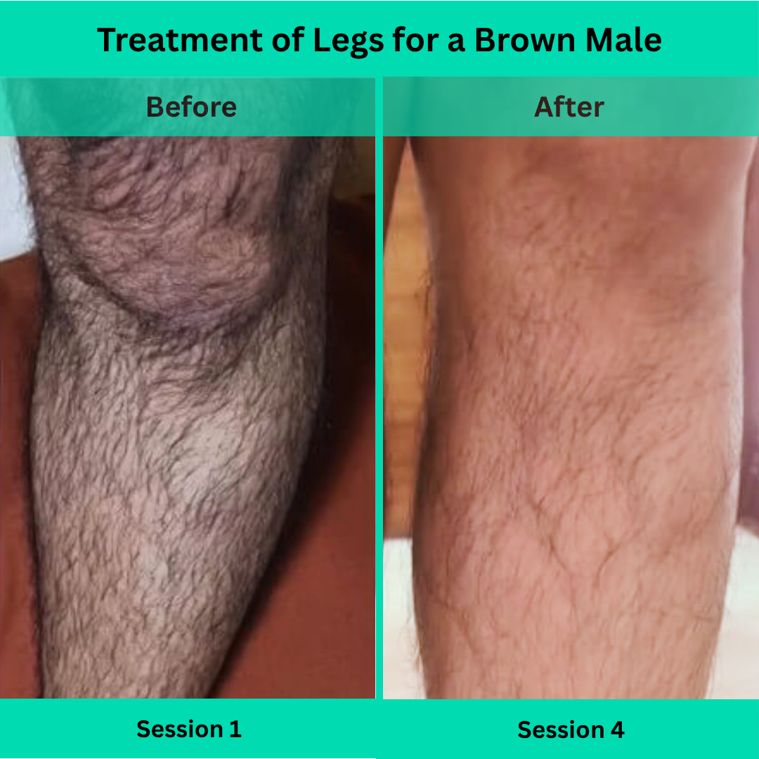 Before and After picture of Laser Hair Removal Treatment of Legs for a Male